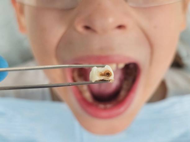 Best Emergency Dental Care for Broken or Chipped Teeth in Mitchellville, MD